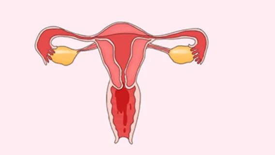 什么是阴道血管肉瘤