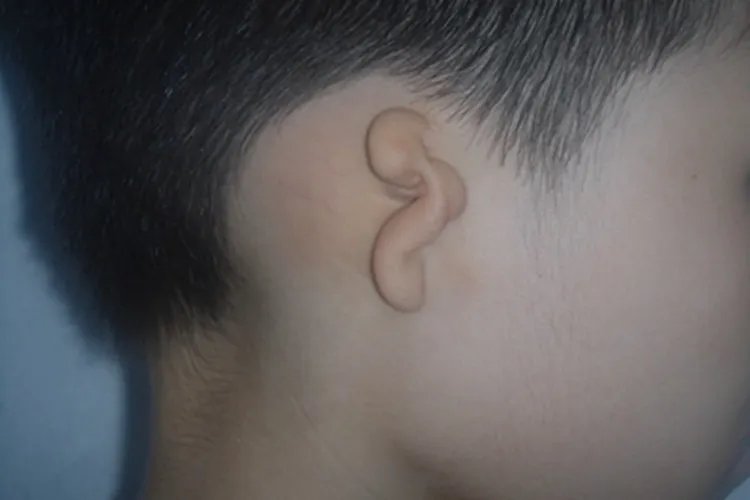 5P-综合征畸形图片