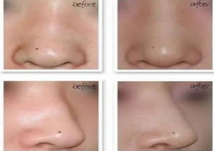鼻翼整形的价格