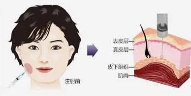 瘦脸针BOTOX的原理是什么？