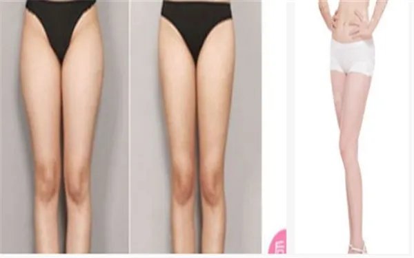 大腿吸脂案例对比