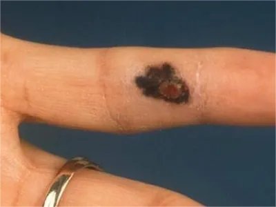 恶性雀斑样痣黑斑图片