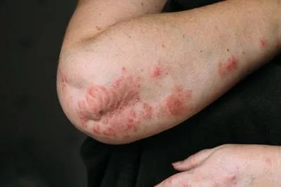 得了慢性荨麻疹该怎样治疗呢