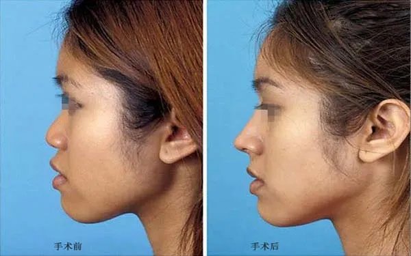 北京做耳软骨隆鼻好的医院在哪里