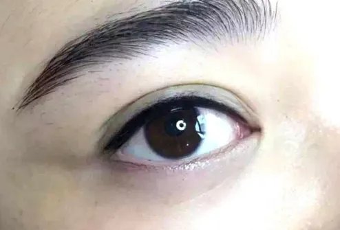 除眼袋手术有危险吗