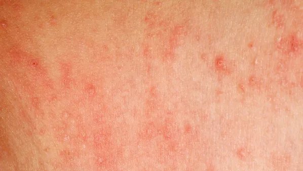 宝宝过敏性皮炎的症状