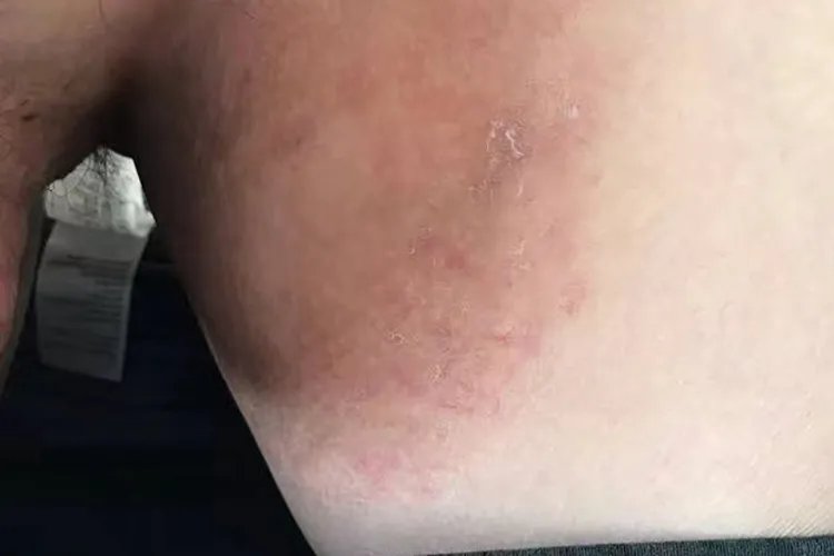 睾丸旁边大腿内侧红斑图片