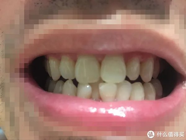 贝医生声波电动牙刷使用心得