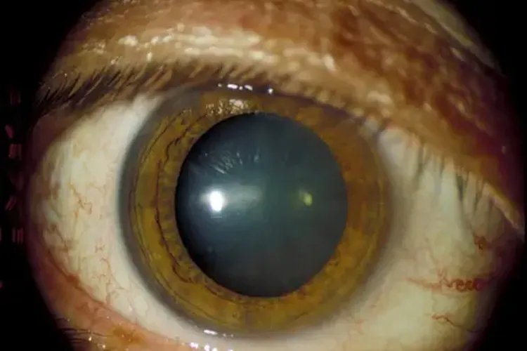 白内障分期分为四期图片