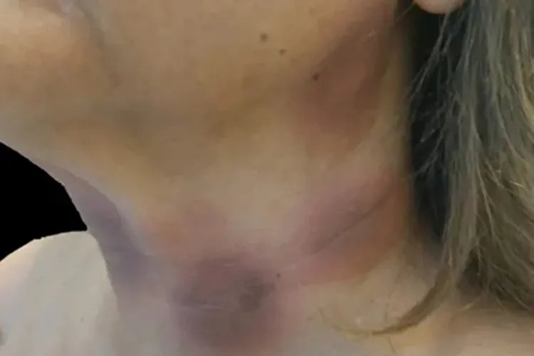 脖子皮肤过敏图片