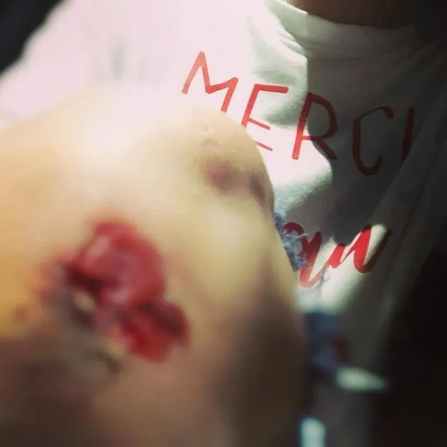 阿娇为拍月食摔跤:伤口似乎挺严重,这么大个口子