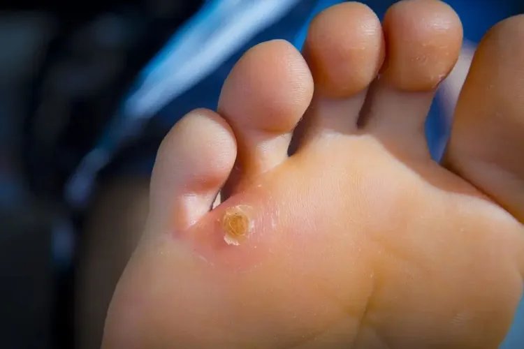 儿童脚底长鸡眼图片