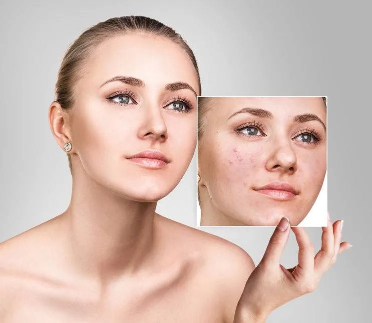 怎么样可以有效祛痘