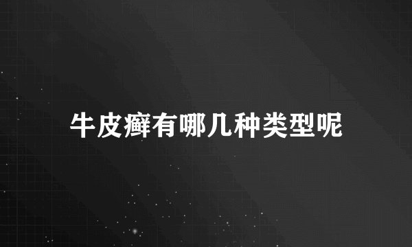 牛皮癣有哪几种类型呢