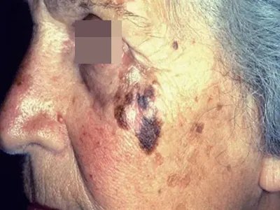 恶性雀斑样痣黑斑图片