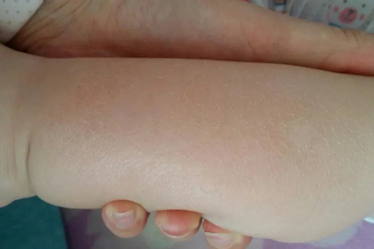 宝宝皮肤干燥起皮图片