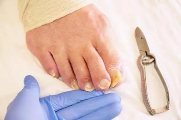 怎样治疗灰指甲最快 解决灰指甲的方法