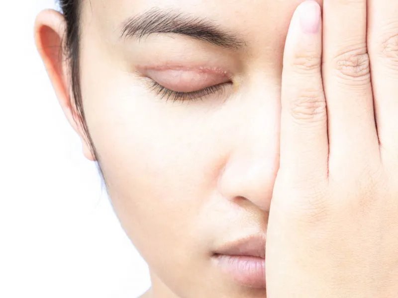 吸脂去除眼袋的作用