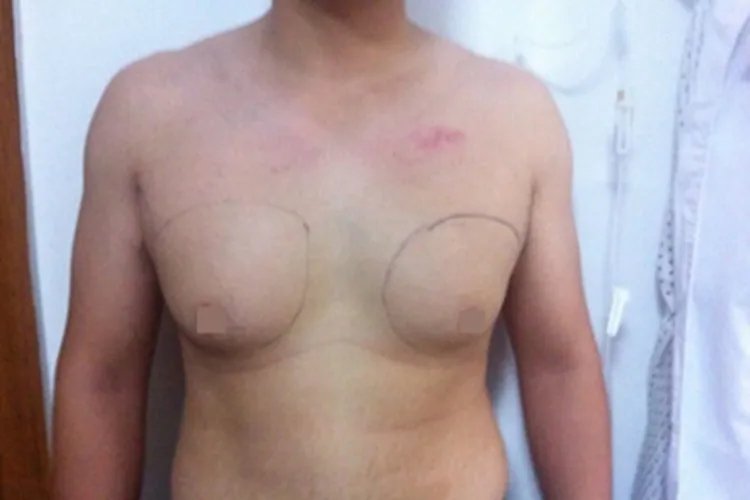 男性乳房肥大症症状图片