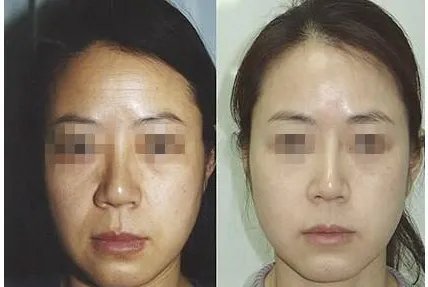 德沃玻尿酸到底好不好