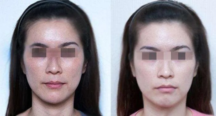 光子嫩肤缩小毛孔多少钱