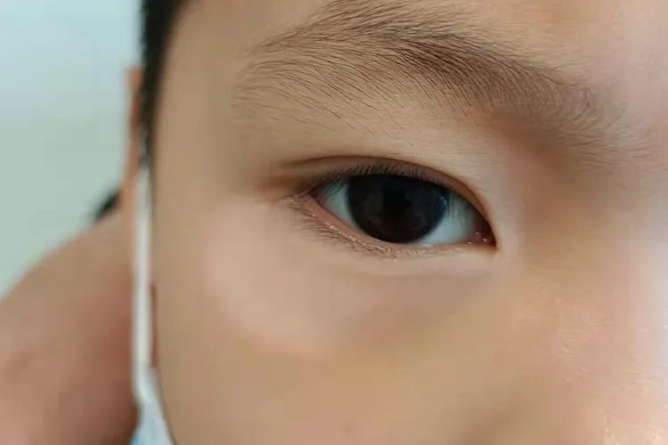 轻度白斑早期症状图片