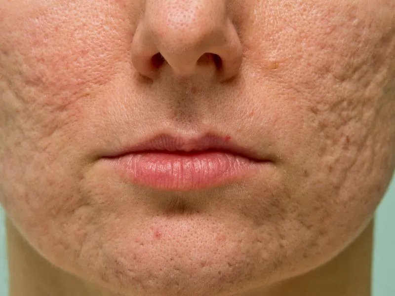 脸上皮肤粗糙的原因