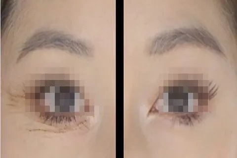 眼部下方细纹图片