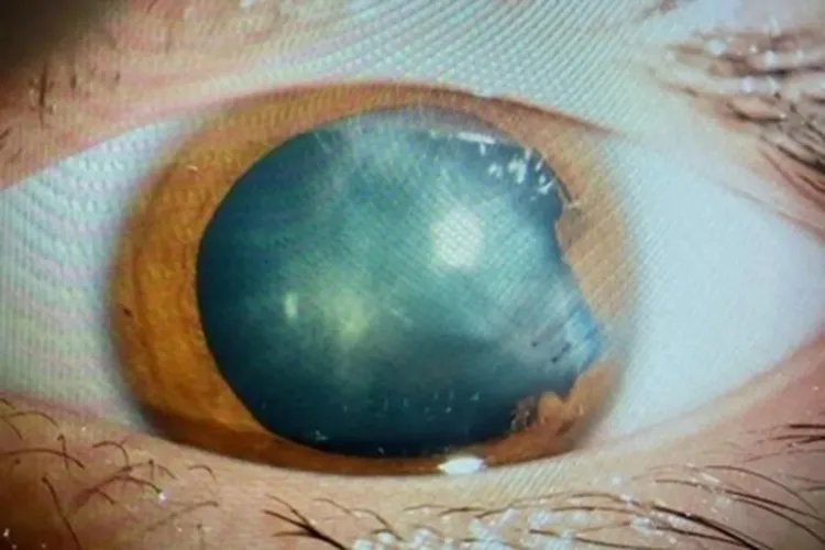 电击伤所致白内障混浊图片