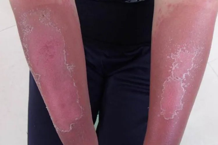 晒斑和黄褐斑区别图片