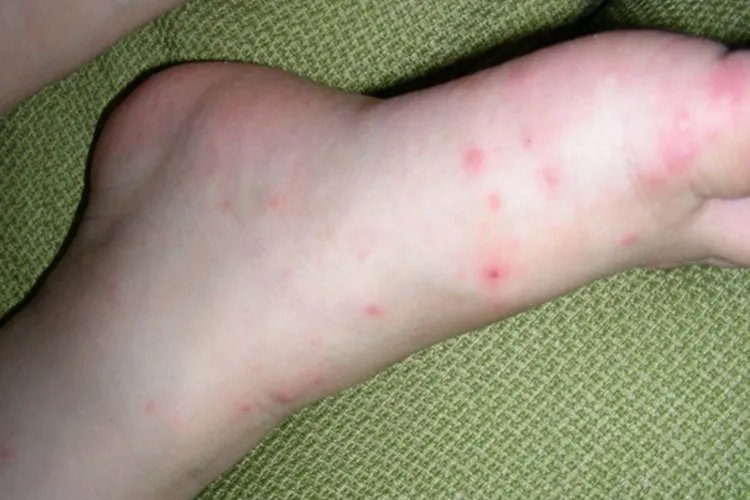 手足口病刚开始的图片