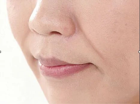 打玻尿酸填充鼻唇沟多少价位