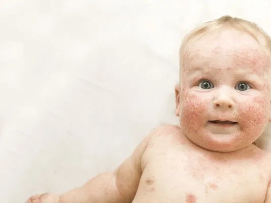 新生儿皮下坏疽的症状