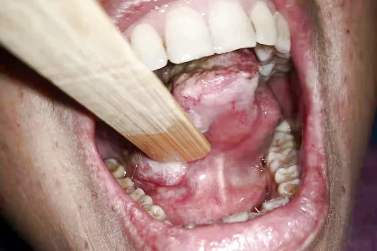 舌底癌图片是什么样子