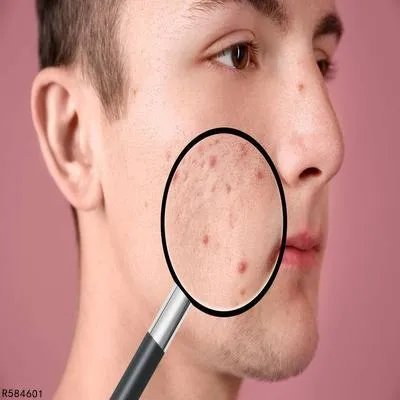 痤疮需要检查什么 通过做4个检查可以确诊痤疮