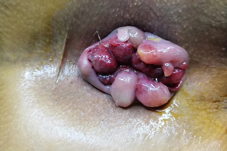 什么是痔疮图片