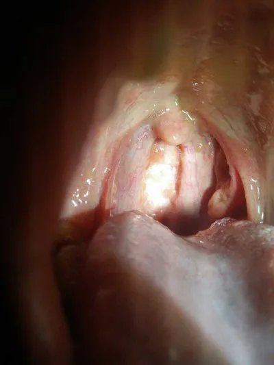 口腔蝇蛆病感染的症状