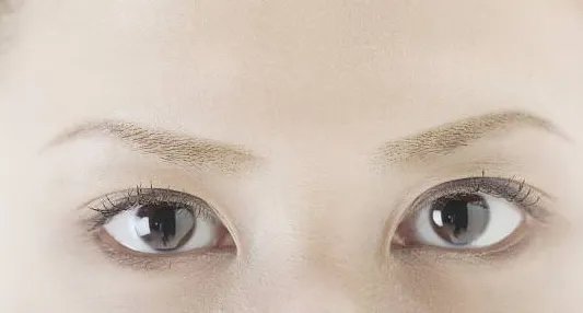 定点双眼皮优势