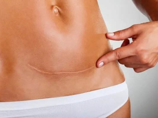 二胎剖腹产手术需要提前多久进行