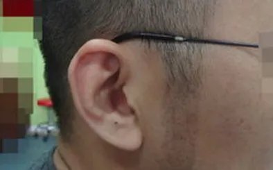 鬓角移植的危害