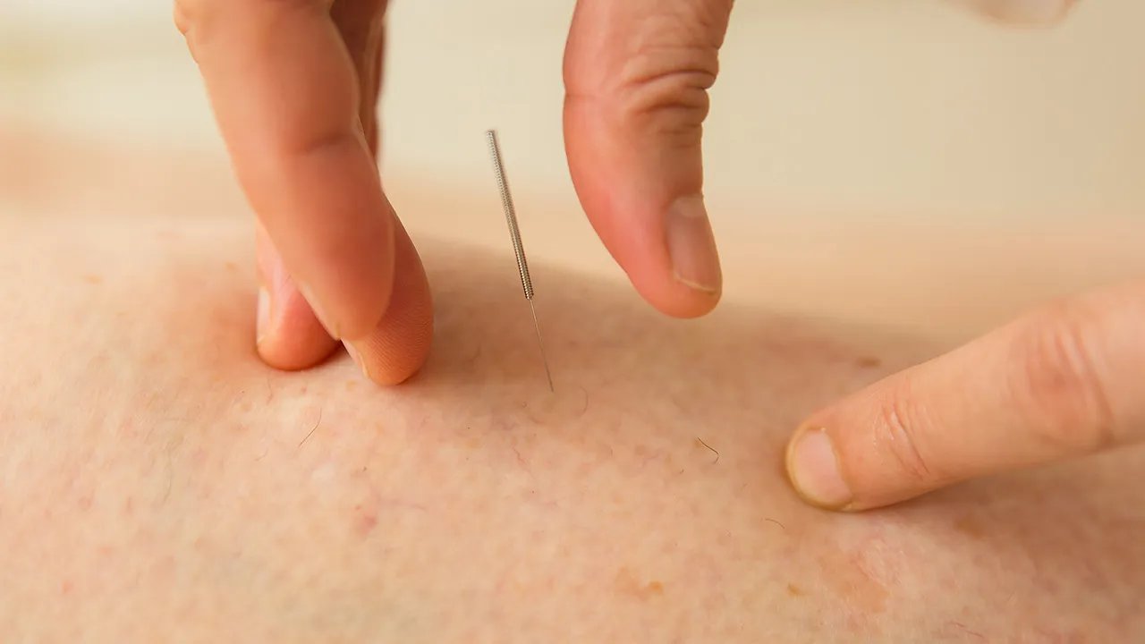 针灸减肥的副作用有哪些