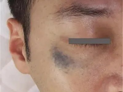 恶性雀斑样痣黑斑图片