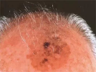 恶性雀斑样痣黑斑图片