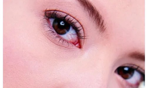 填充泪沟要多少钱