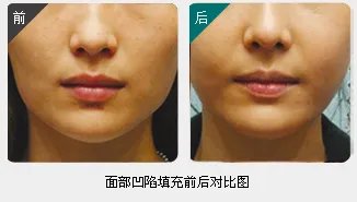 抽脂填充风险有哪些