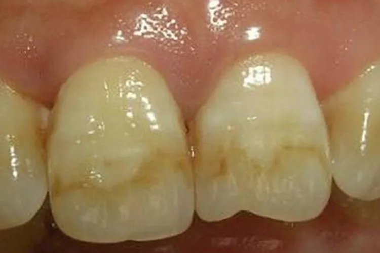 外源性色素沉着异常发黄图片