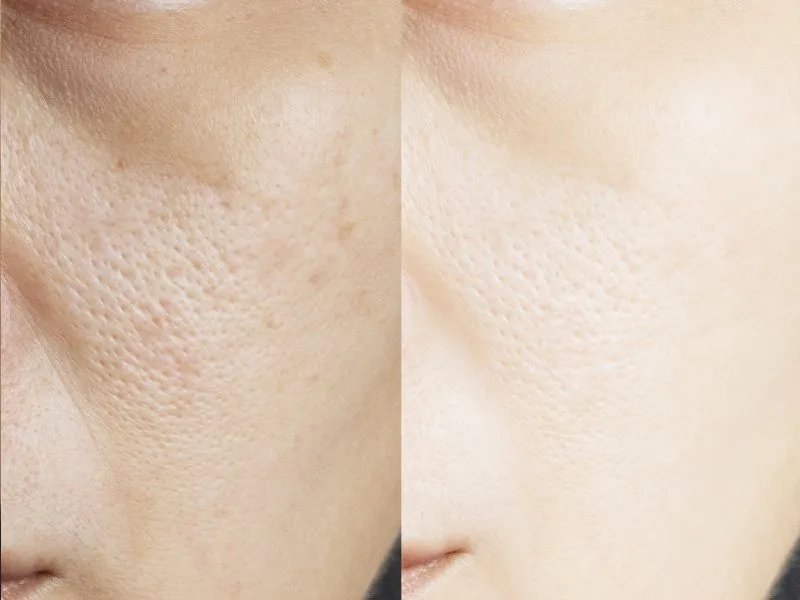 米醋可以祛斑吗