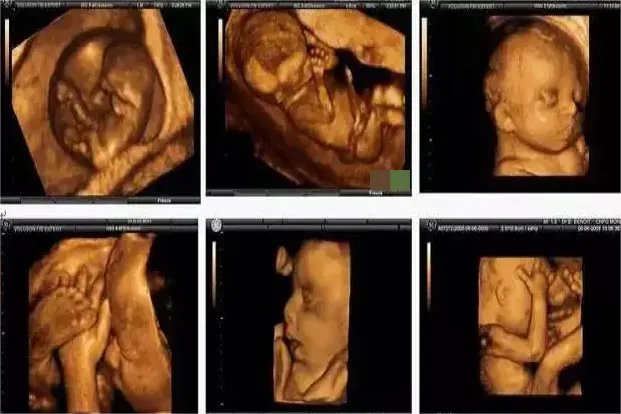 四维彩超是什么样的图片