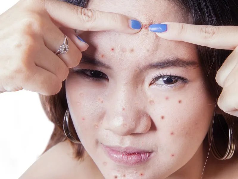 严重的痤疮怎么办