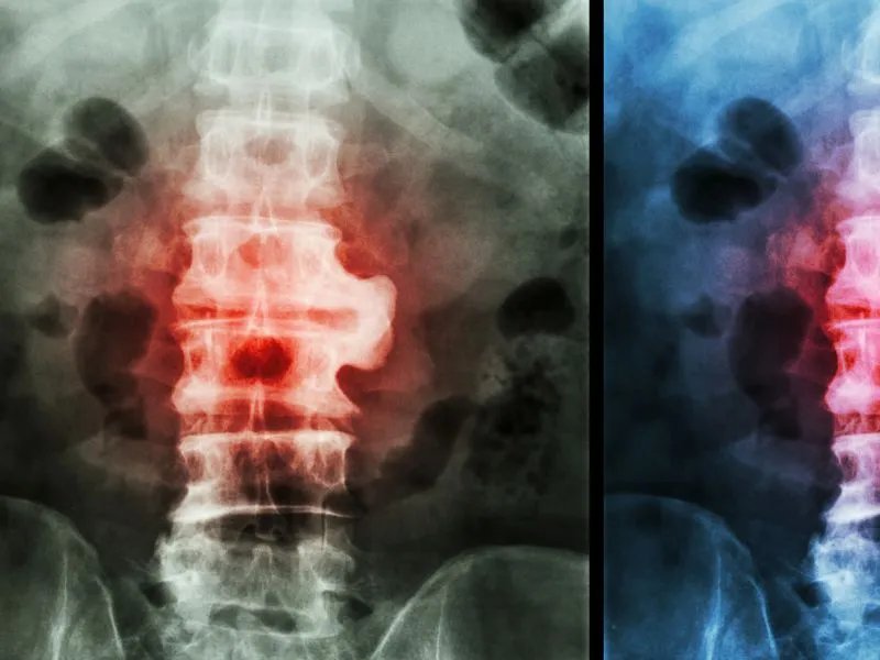 腰椎盘突出微创手术风险有多大